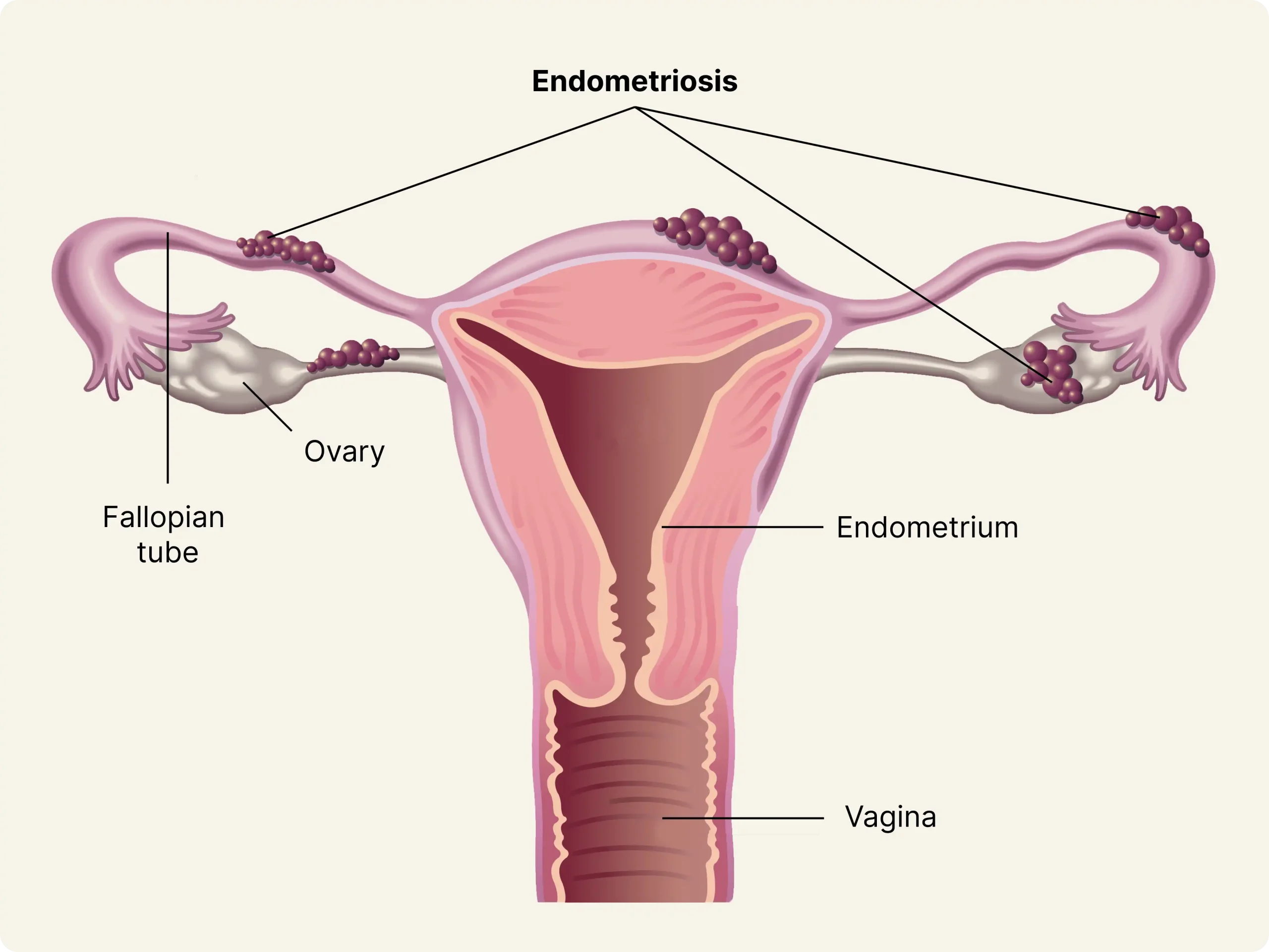 Management of Severe Endometriosis