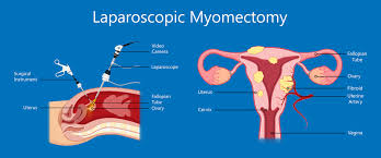 Laparoscopic Myomectomy for Large Fibroids